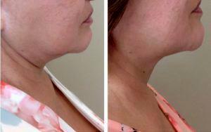 Kybella For Unwanted Jowls At Skinique Med Spa & Wellness