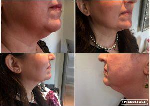 Kybella Injections At Skin Deep Med Spa In Boston