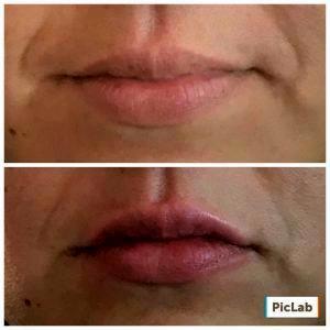 Lip Augmentation At Dolce Aesthetics NYC (1)