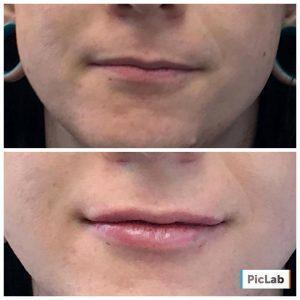 Lip Augmentation At Dolce Aesthetics NYC (2)