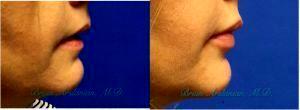 Lip Augmentation By Dr. Brian Arslanian, Plastic Surgeon In Atlanta, GA (2)