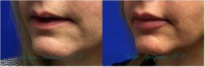 Lip Augmentation By Dr. Brian Arslanian, Plastic Surgeon In Atlanta, GA (3)
