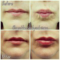 Lip Augmentation With Juviderm