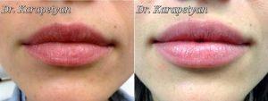 Lip Aumentation By Doctor Arman F. Karapetyan, MD, Glendale Physician
