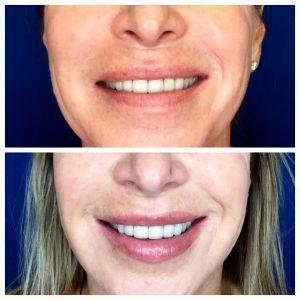 Lip Enhancement Can Give Your Lips A Full, But Natural Appearance At Skintastic Cosmetic Surgery And Laser Skincare Centers In Dallas