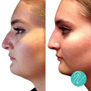 Liquid Rhinoplasty With Juvederm Filler At The Skin Center In Columbus, Ohio