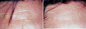 Male Botox Before And After By Dr George Lefkovits, MD, New York Plastic Surgeon