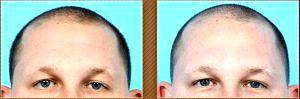 Male Botox by Dr. Steven H. Dayan, MD, Doctor in Chicago, Illinois