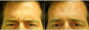 Male Patient Treated With Botox In Brow Furrow - 5 Days Post Treatment