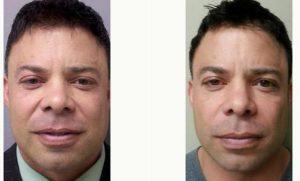Man Treated With Juvederm Before & After By Dr. Jeffrey Horowitz, MD, Bel Air Plastic Surgeon