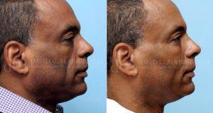 Man Treated With Restylane Before & After By Dr David C. Mabrie, MD, Bay Area Facial Plastic Surgeon