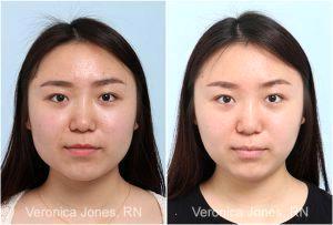 Mastication Botox By Veronica Jones, RN At Mirror Mirror Beauty Boutique In Houston, Texas