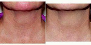 Micro-Botox For Neck Rejuvenation Before And After By Dr Jeffrey S. Rosenthal, MD, Fairfield Plastic Surgeon