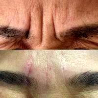 Most Types Of Botox Injections Work The Same On Forehead Wrinkles