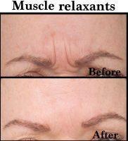 Muscle Relaxants Before And After