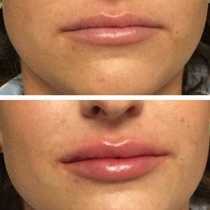 Natural Fuller Lip. Juvederm 1ml Used To Get These Beautiful Lips At Glo Medspa, Medical Spa In Scottsdale, Arizona