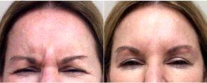 No More Brow Furrow With Botox By Dr. Marguerite A. Germain, MD, Charleston Dermatologic Surgeon