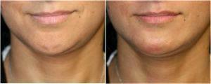 Non-Surgical Chin Augmentation utilizing Radiesse Filler by Dr. Otto J. Placik, Chicago Plastic Surgeon (1)