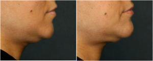 Non-Surgical Chin Augmentation utilizing Radiesse Filler by Dr. Otto J. Placik, Chicago Plastic Surgeon (2)