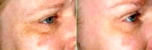 Non-surgical Botox Eye Rejuvenation By Doctor Mary P. Lupo, MD, New Orleans Dermatologist