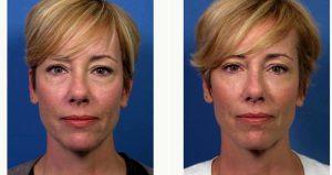 Non-surgical Lower Eyelid Rejuvenation Before & After With Doctor John M. Hilinski, MD, San Diego Facial Plastic Surgeon