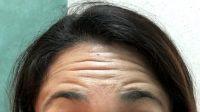 OnabotulinumtoxinA For Forehead Lines