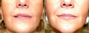 One Syringe Of Filler To Her Upper Lip By Dr. Elisa A. Burgess, Plastic Surgeon In Lake Oswego, Oregon