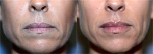 One Syringe Of Restylane Silk To Her Upper And Lower Lip By Dr. Elisa A. Burgess, Plastic Surgeon In Lake Oswego, Oregon