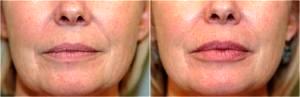 One Syringe Of Restylane To The Lips By Dr. Elisa A. Burgess, Plastic Surgeon In Lake Oswego, Oregon