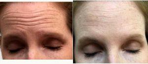 Patient Treated With Botox For Forehead Lines