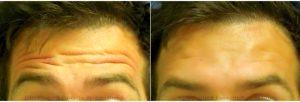 Patient Treated With Botox & Restylane Fillers In Forehead - Pre- 5 Days Post Treatment
