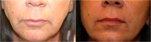 Perlane-L In Her Marionette Lines And Nasolabial Folds By Dr. Elisa A. Burgess, Plastic Surgeon In Lake Oswego, Oregon