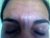 Pic Of Botox Between Eyebrows And Forehead