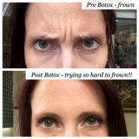 Pre And Post Botox On Frowning Lines