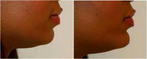 Radiesse Filler Injected to the Chin & Nasolabial Folds by Dr. Otto J. Placik, Chicago Plastic Surgeon (2)