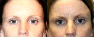 Radiesse Filler Injected to the temples by Dr. Otto J. Placik, Chicago Plastic Surgeon (1)