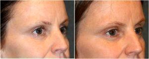 Radiesse Filler Injected to the temples by Dr. Otto J. Placik, Chicago Plastic Surgeon (2)