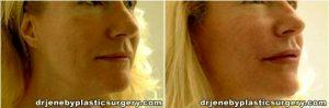 Radiesse In The Folds And Hylaform In The Lips. After Photos Were Taken 6 Months After Surgery Procedure