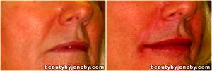 Radiesse Injection In The Folds And In The Lips By Dr. Thomas Jeneby