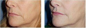 Radiesse, Juvederm Ultra Plus, Belotero And Botox By Dr. Dina Eliopoulos, MD, Chelmsford MA Plastic Surgeon