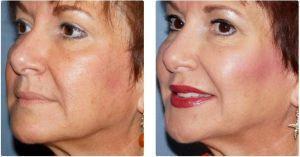 Radiesse, Voluma And Juvederm Ultra By Dr. Dina Eliopoulos, MD, Chelmsford MA Plastic Surgeon