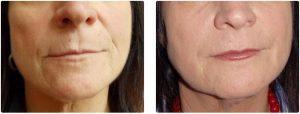 Radiesse X2 Syringes & Juvederm X1 Syringe By Dr. Dina Eliopoulos, MD, Chelmsford MA Plastic Surgeon