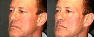 Radiesse to various facial areas by Dr. Otto J. Placik, Chicago Plastic Surgeon (1)