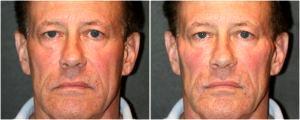 Radiesse to various facial areas by Dr. Otto J. Placik, Chicago Plastic Surgeon (2)