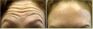 Raising Eyebrows 2 Weeks Before And After With Dr. Tricia Brown, Dermatologist In Houston, TX