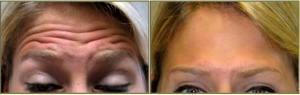 Raising Eyebrows Before And 1 Week After By Dr. Tricia Brown, Dermatologist In Houston, TX