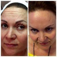 Reduce Facial Dynamic Wrinkles