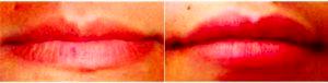 Restylane Before & After By Dr. Todd Schlifstein, DO, New York Physician