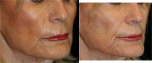 Restylane Filler injection to the Cheeks, Jowl Regions & Upper Lip by by Dr. Otto J. Placik, Chicago Plastic Surgeon (1)
