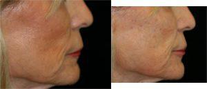 Restylane Filler injection to the Cheeks, Jowl Regions & Upper Lip by by Dr. Otto J. Placik, Chicago Plastic Surgeon (2)